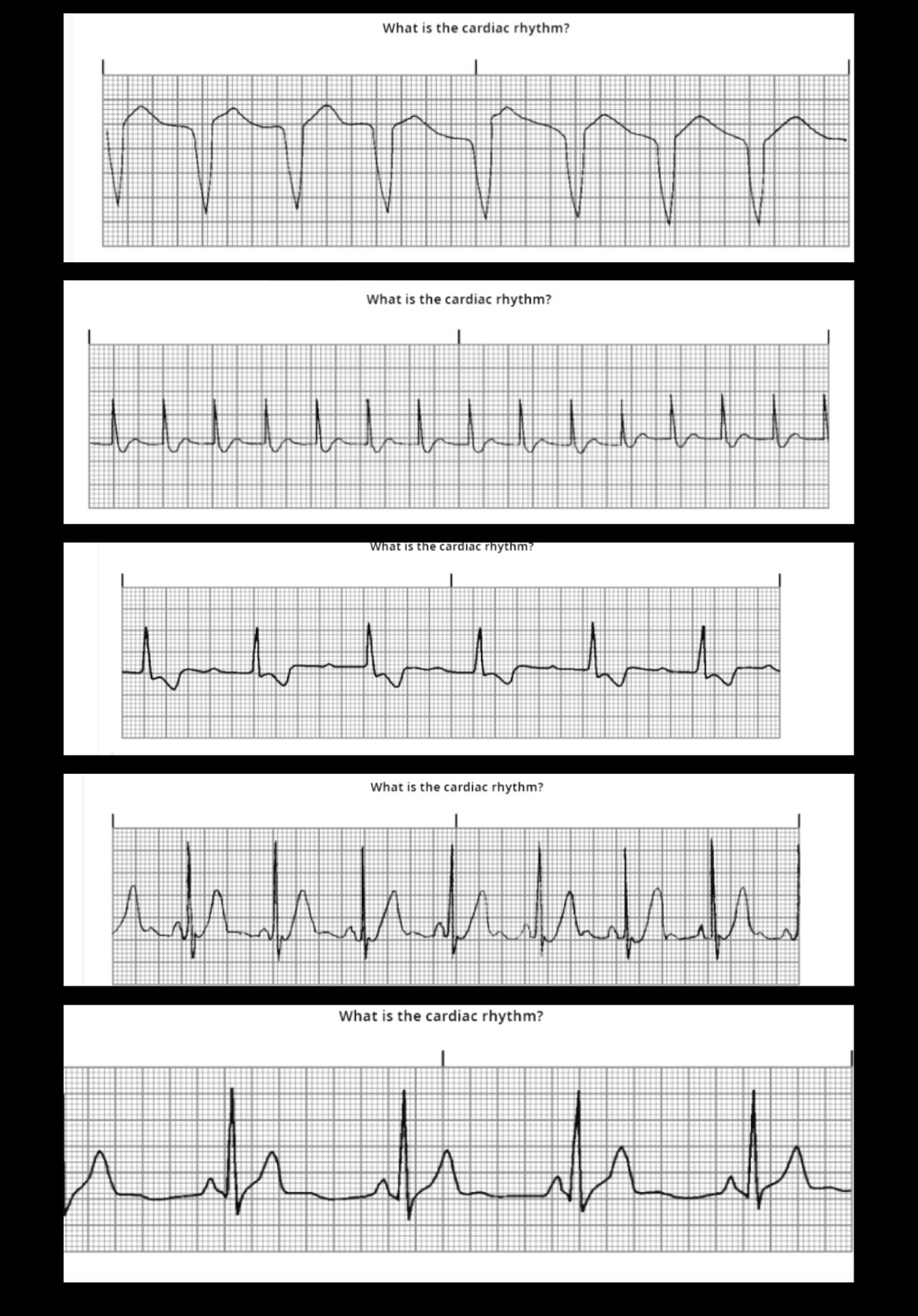 Solved What is the cardiac rhythmWhat is the cardiac | Chegg.com