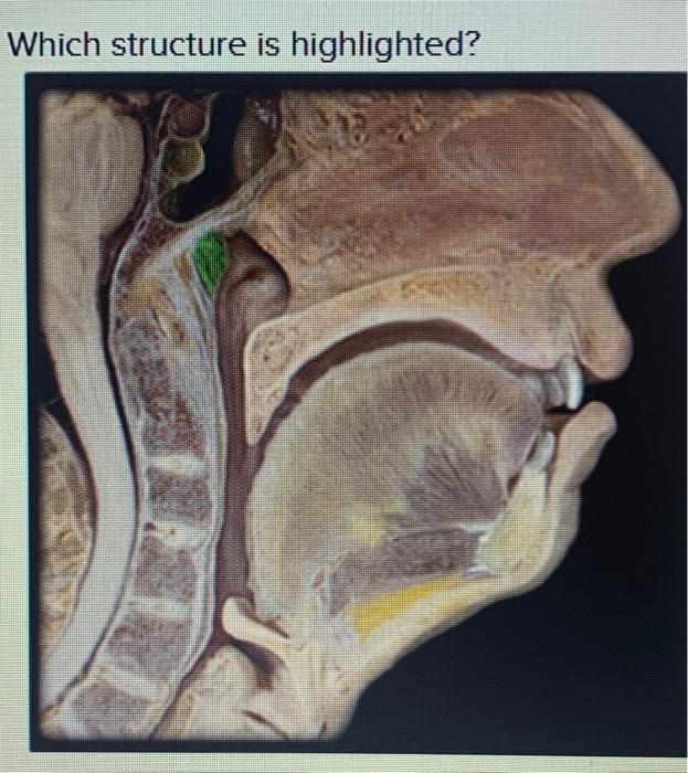 Solved Which structure is highlighted? uvula O palatine | Chegg.com