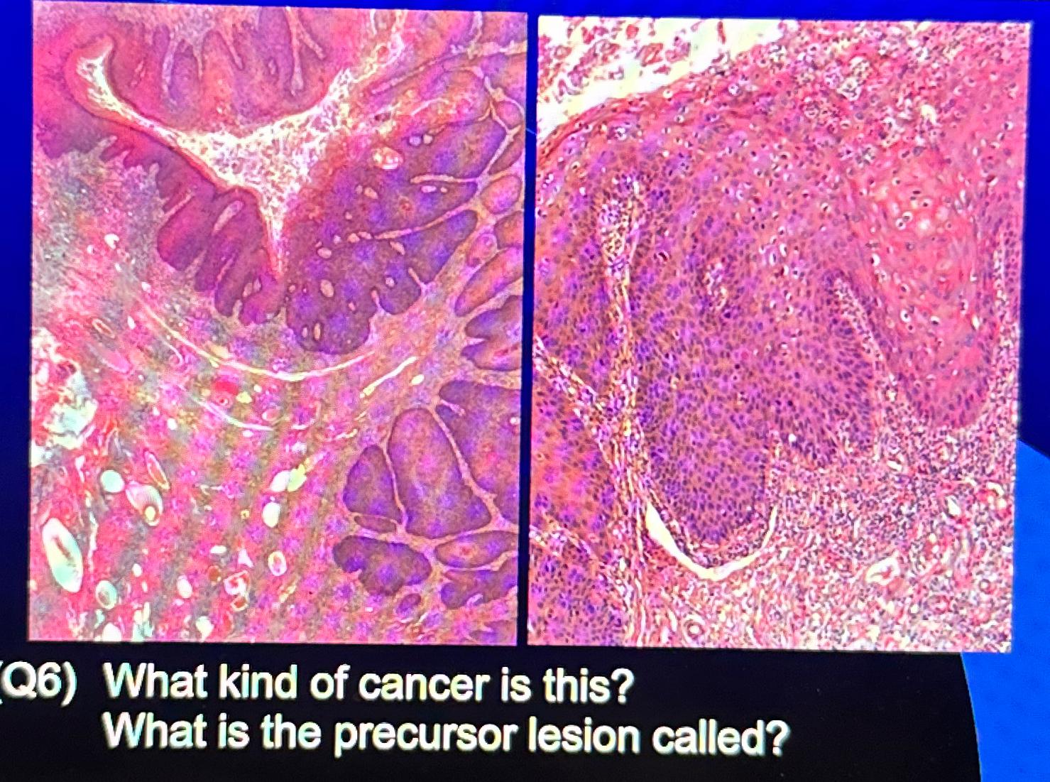 solved-what-kind-of-cancer-is-this-what-is-the-precursor-chegg