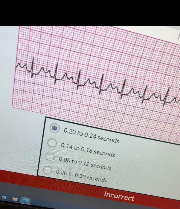 Solved Sinus Rhythm with 1st Degree AV Block 2nd Degree Type | Chegg.com