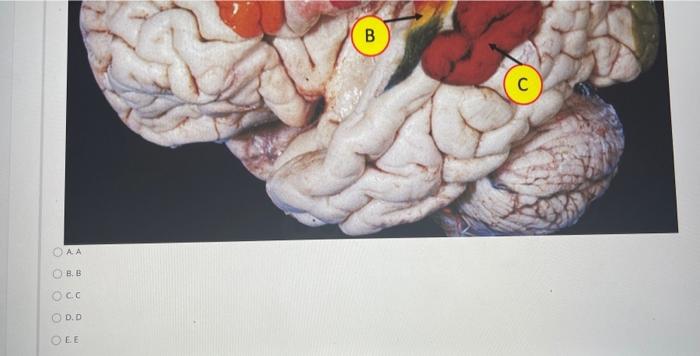 lateral fissure brain