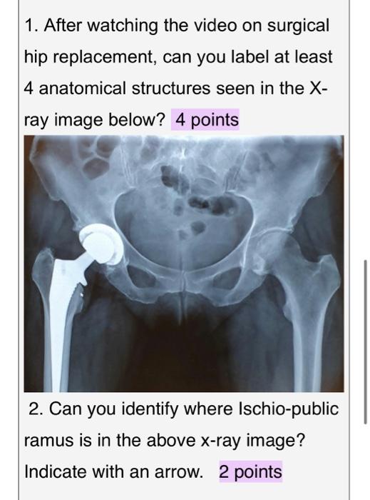 1. After watching the video on surgical hip
