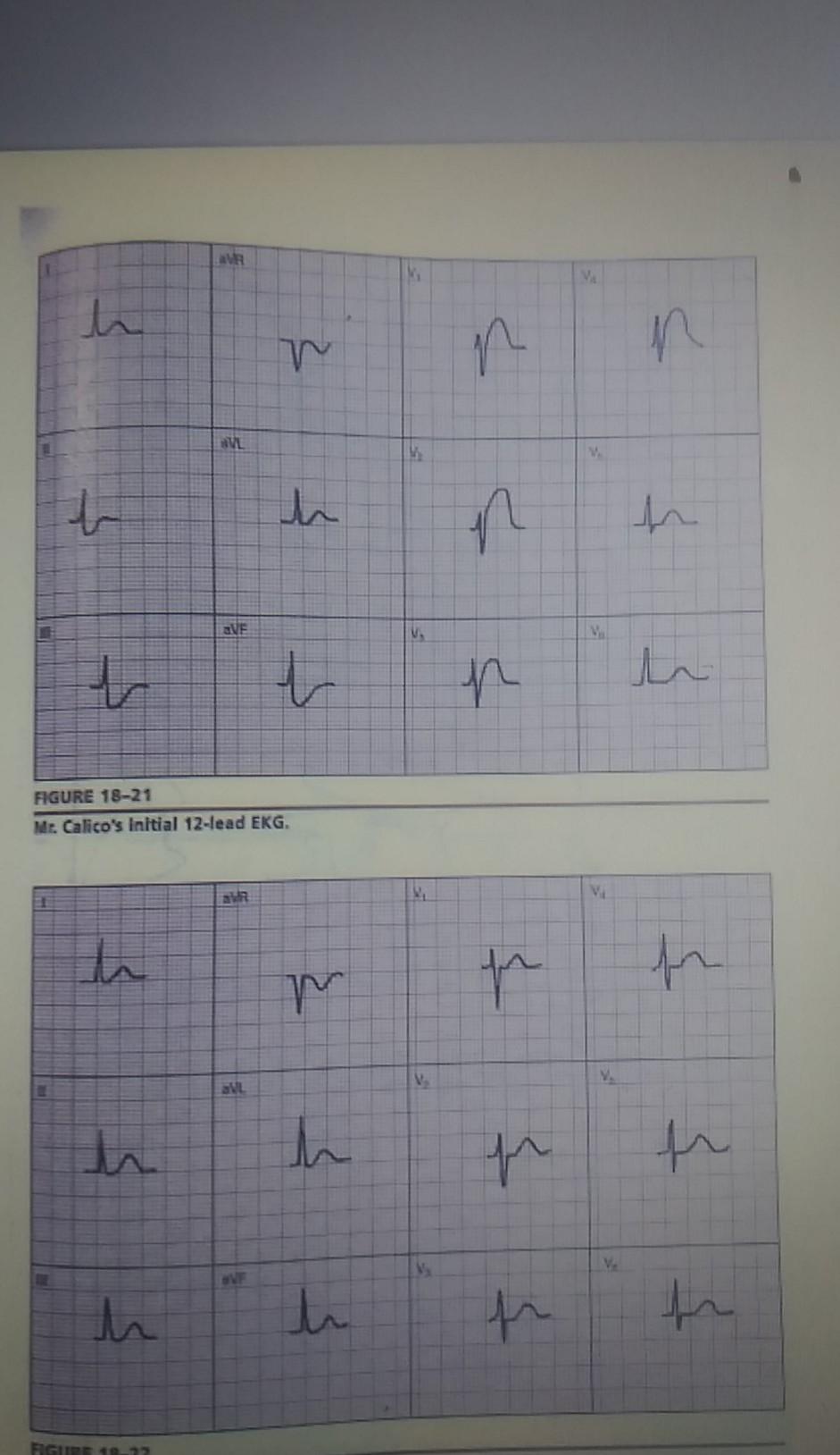 h 르 르 VL L h < - VE t 나 p FIGURE 18-21 Mt. Calicos Initial 12-lead EKG. VI th ㄴ 국 fr 록 SNL tu th ㄴ 록 루 h th fr FIGURE 10-22