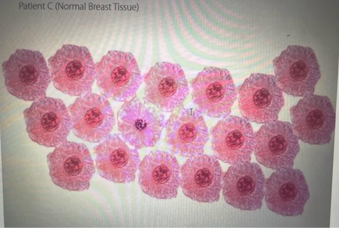 Solved Patient C (Normal Breast Tissue) Patient A | Chegg.com