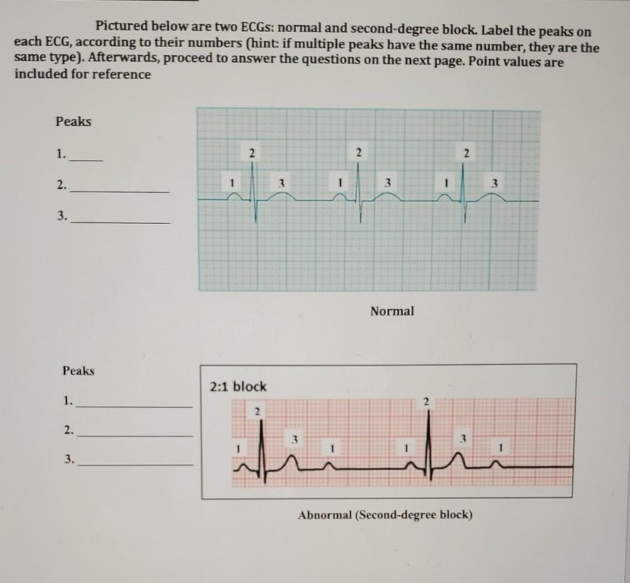 Solved Pictured below are two ECGs: normal and second-degree | Chegg.com