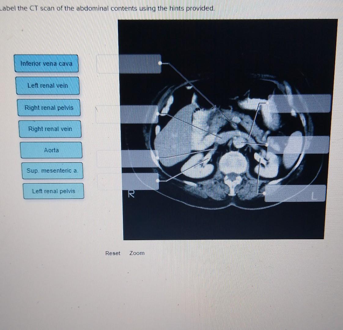 abel the CT scan of the abdominal contents using the hints provided.