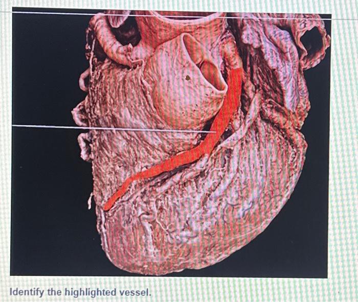 Solved Identify The Highlighted Vessel. | Chegg.com