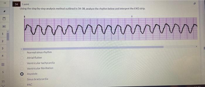 1 point
Using the step by step analysis method outlined in 34-38, analyze the stythm below and interpret the EKG strip.
Norma