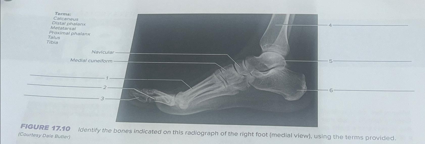 Solved FIGURE 17.10 ﻿Identify the bones indicated on this | Chegg.com