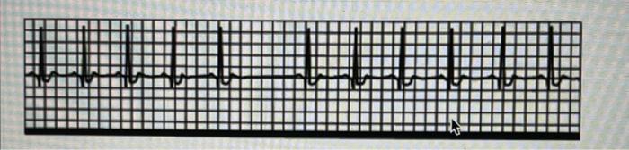 Solved Please Interpret This EKG. Choices | Chegg.com