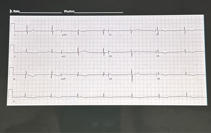 Solved 2. Rate 11 11 Rhythm_ aVR aVL + aVF 가 + r 1 V1 ↓ V2 | Chegg.com