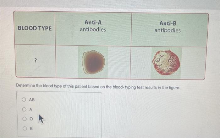 Solved Determine The Blood Type Of This Patient Based On The | Chegg.com