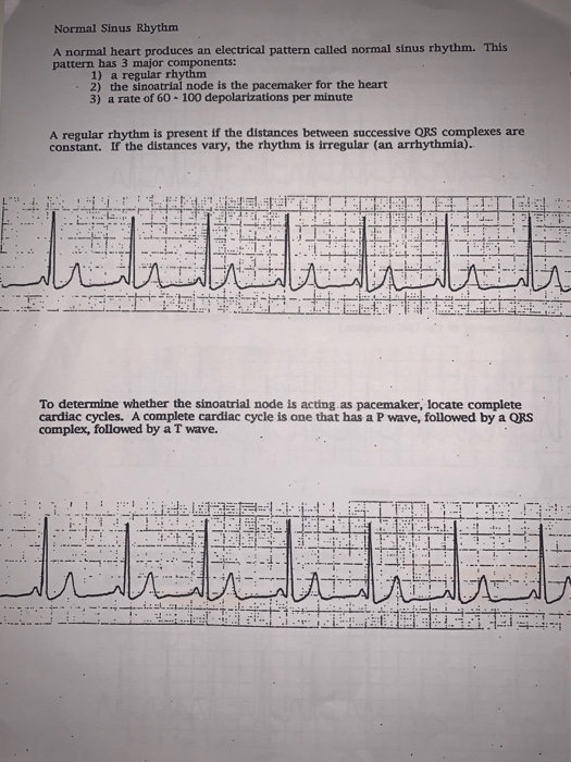 Solved Normal Sinus Rhythm A normal heart produces an | Chegg.com