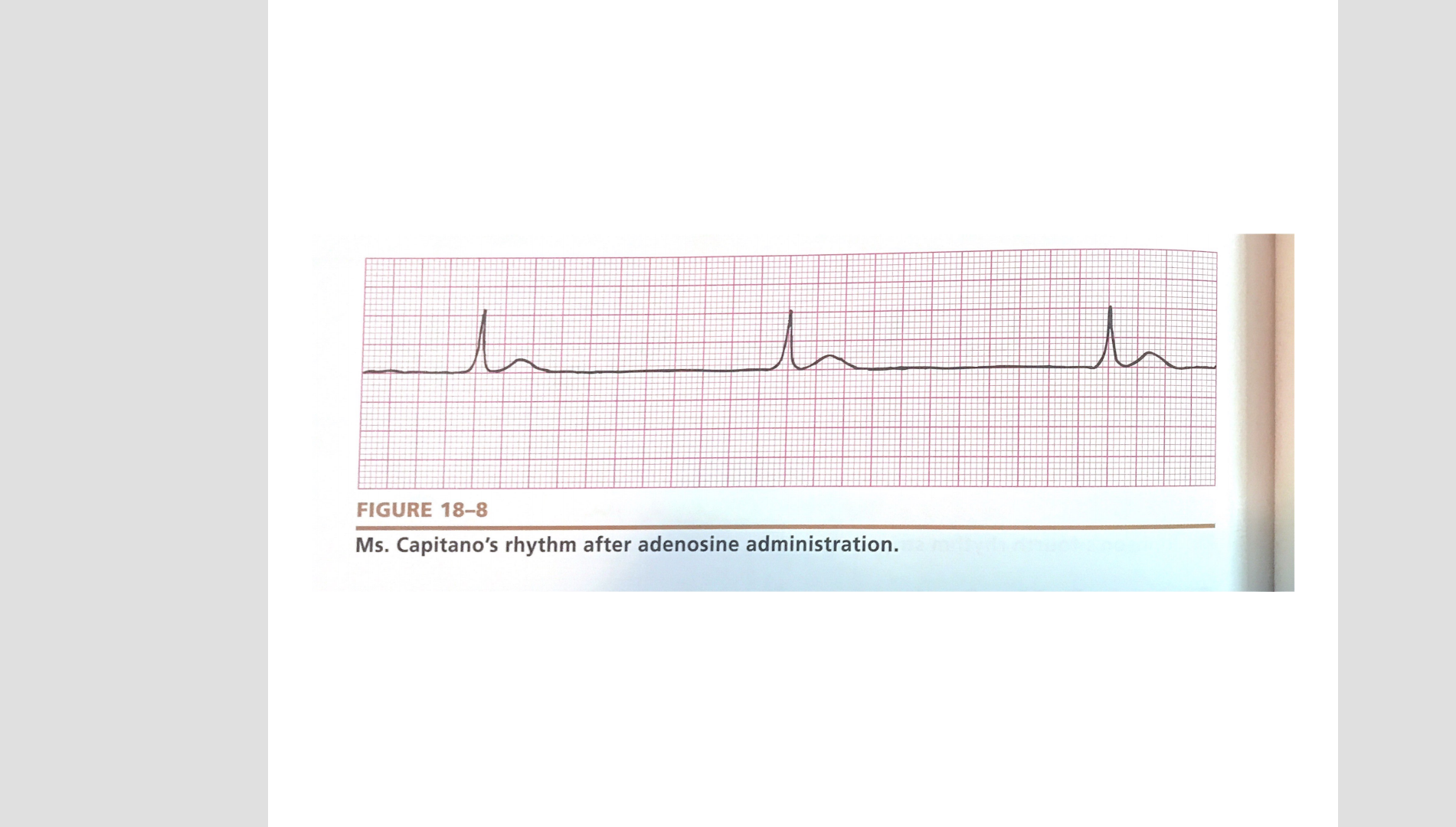 h FIGURE 18-8 Ms. Capitanos rhythm after adenosine administration.