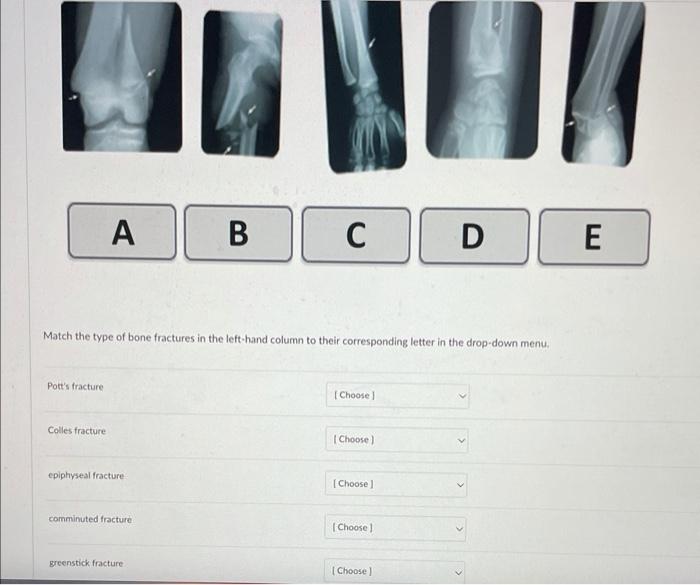 Solved Match the type of bone fractures in the lefthand