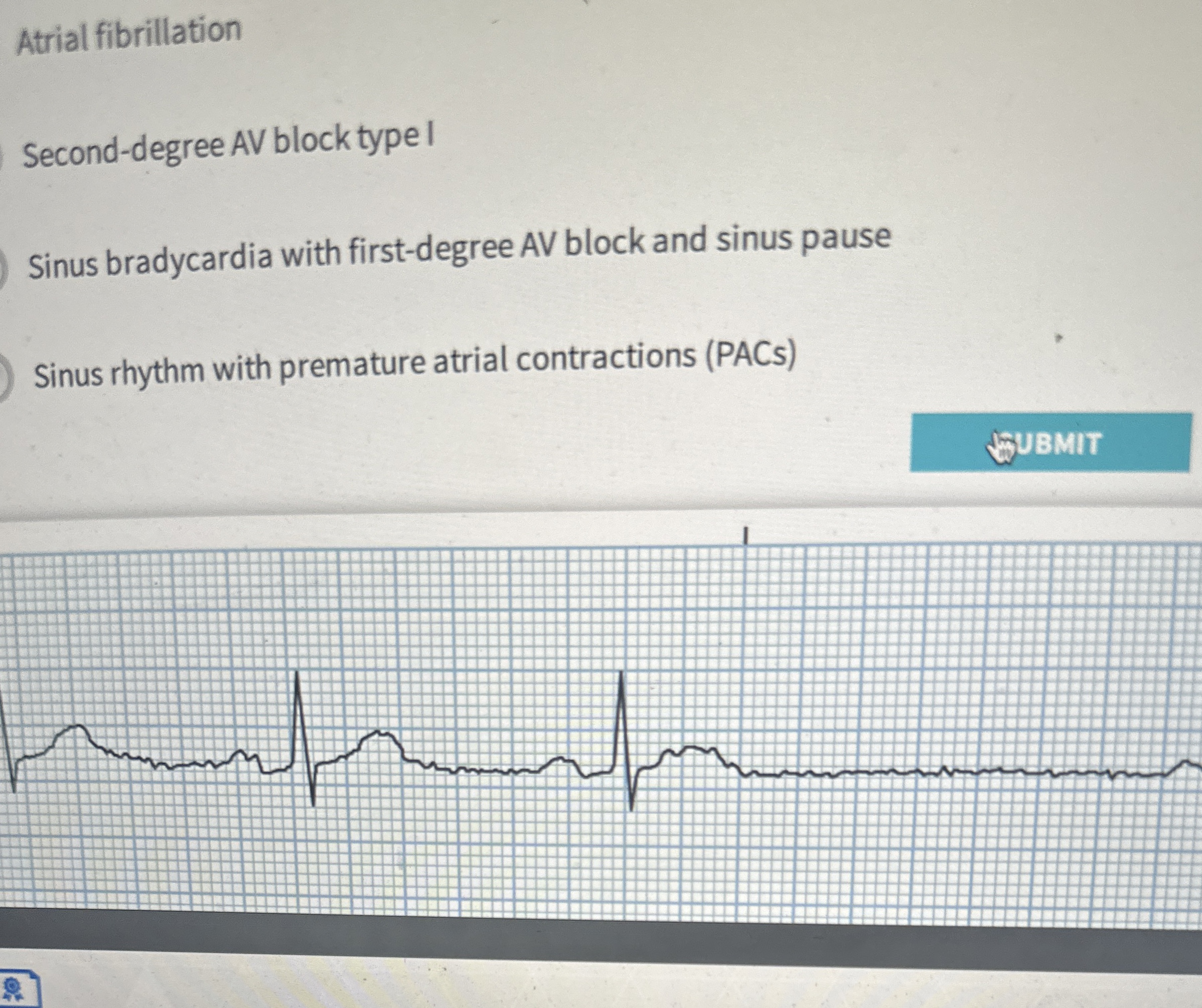 Solved Atrial fibrillationSecond-degree AV block type ISinus | Chegg.com