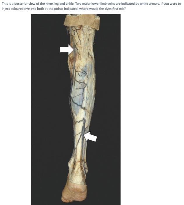 This is a posterior view of the knee, leg and ankle. Two major lower limb veins are indicated by white arrows. If you were to