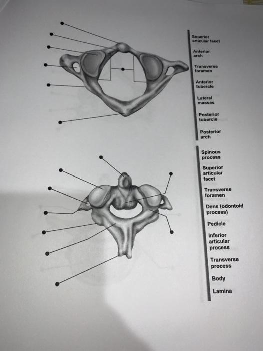 Solved Superior articular facet Anterior arch Transverse | Chegg.com