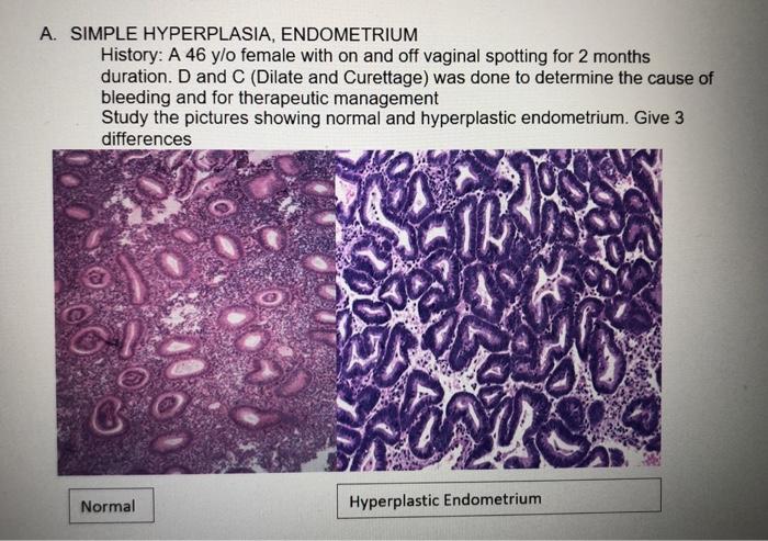 A. SIMPLE HYPERPLASIA, ENDOMETRIUM History: A 46 y/o female with on and off vaginal spotting for 2 months duration. D and C (