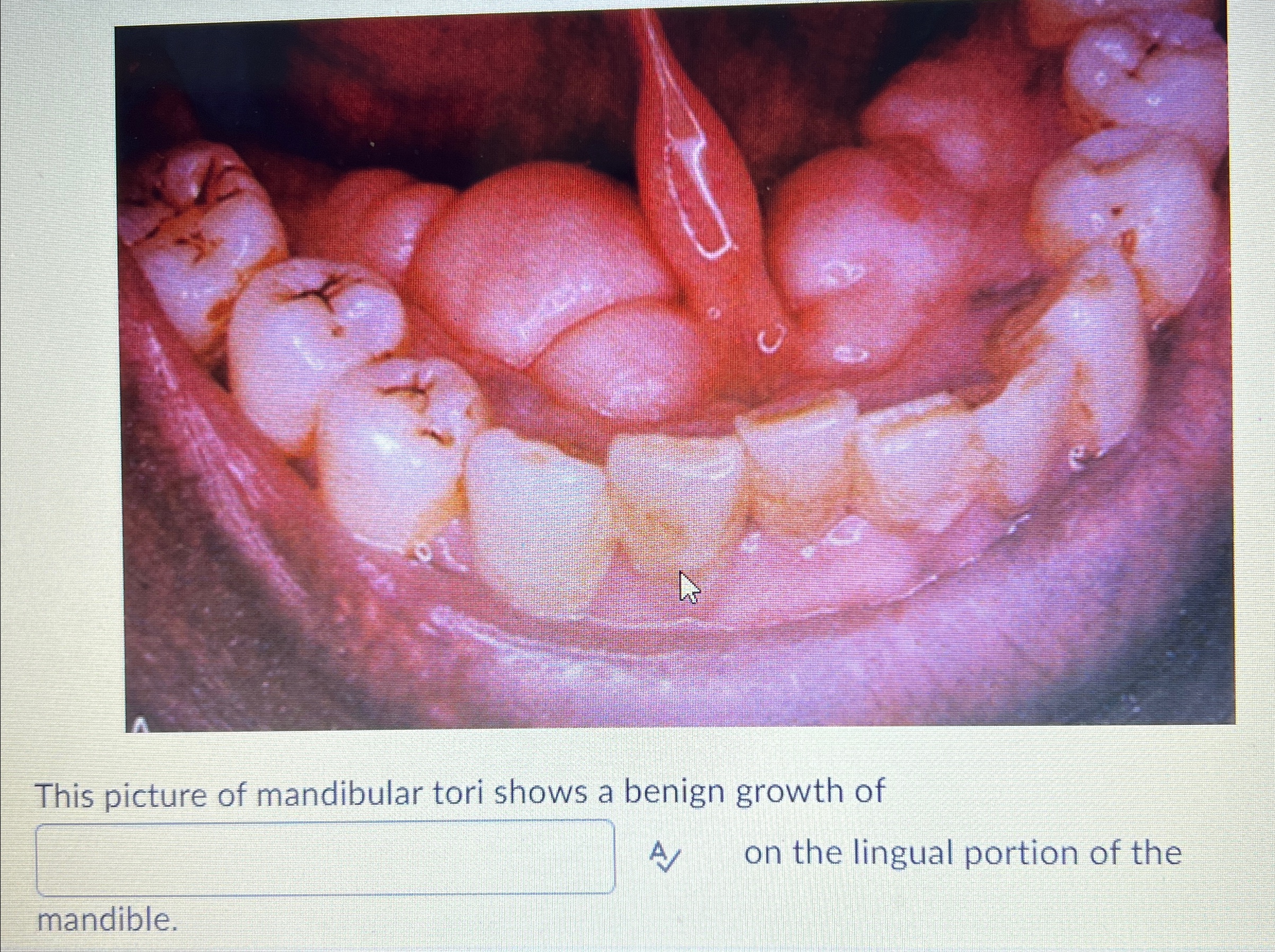 Solved This picture of mandibular tori shows a benign growth | Chegg.com