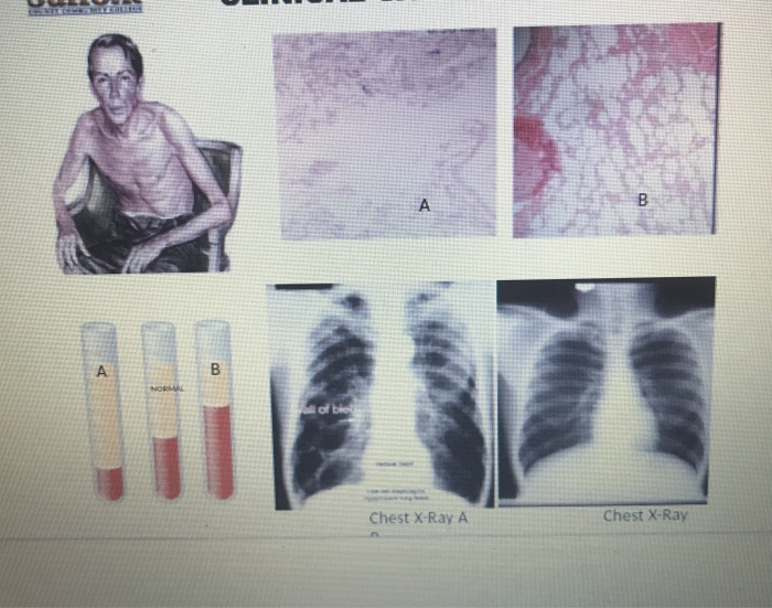 CASE STUDY 3 A 66-year-old male is admitted to the | Chegg.com