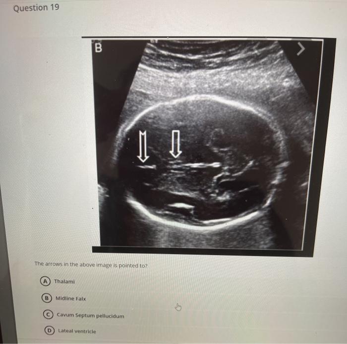 Question 19 B I The arrows in the above image is pointed to? A Thalami B Midline Falx Cavum Septum pellucidum D) Lateal ventr