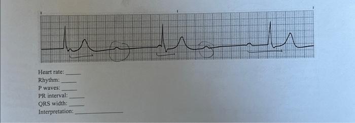 Heart rate: Rhythm: P waves: PR interval: QRS width: | Chegg.com