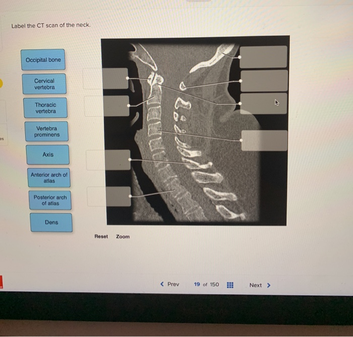 Solved Label the CT scan of the neck. Occipital bone