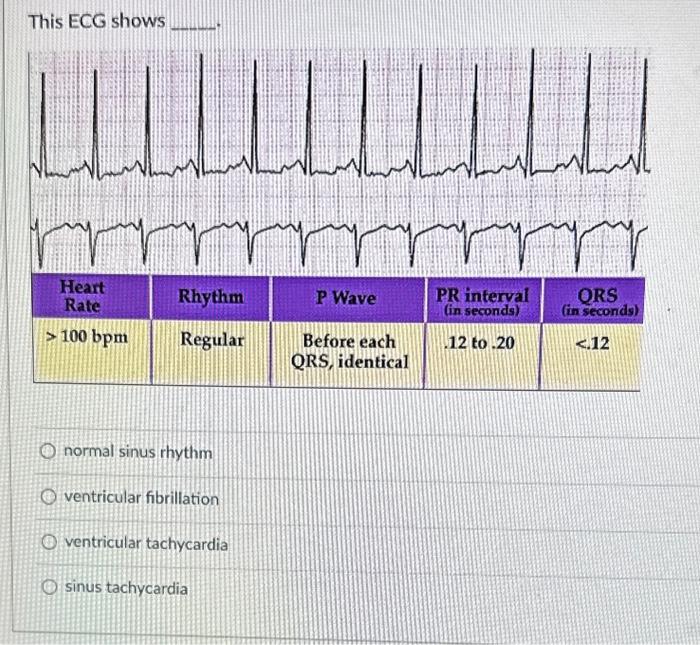 Solved This ECG shows normal sinus rhythm ventricular | Chegg.com