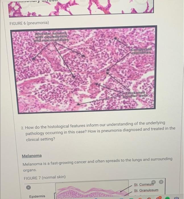 MIT
Try MY
FIGURE 6 (pneumonia)
veolar lumens
with neutrophils
nd macrophiss
Condested
capillaries
2. How do the histological
