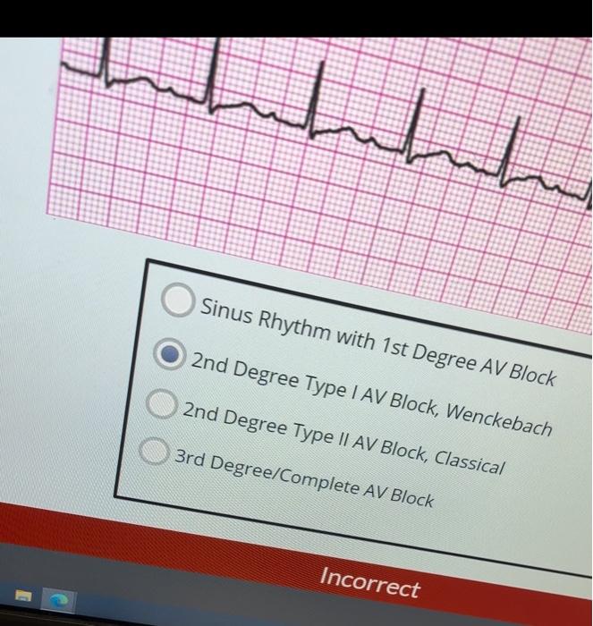 Solved Sinus Rhythm with 1st Degree AV Block 2nd Degree Type | Chegg.com