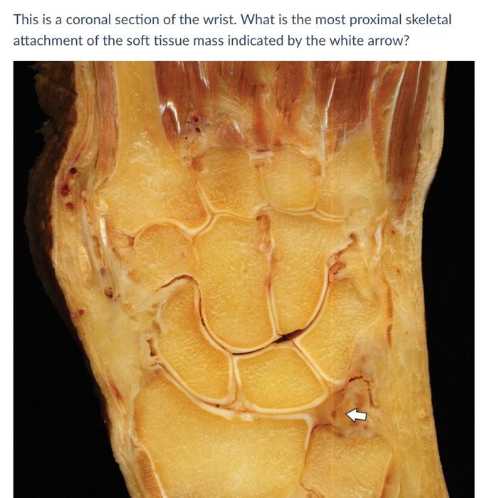 This is a coronal section of the wrist. What is the most proximal skeletal attachment of the soft tissue mass indicated by th