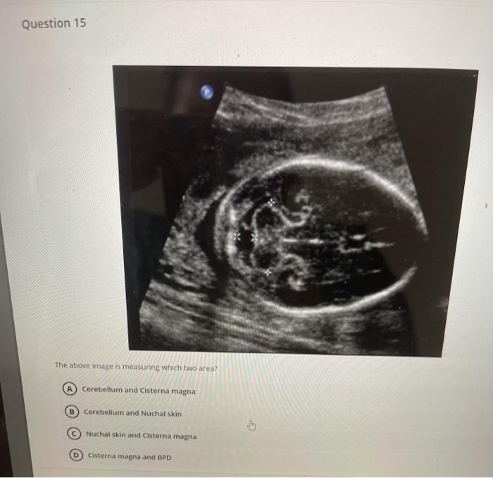 Question 15 The above image is measuring which two area? A Cerebellum and Cisterna magna B Cerebellum and Nuchal skin Nuchal