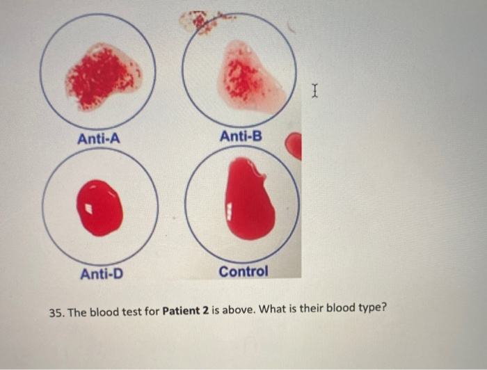 Solved I Anti-A Anti-B Anti-D Control 35. The Blood Test For | Chegg.com