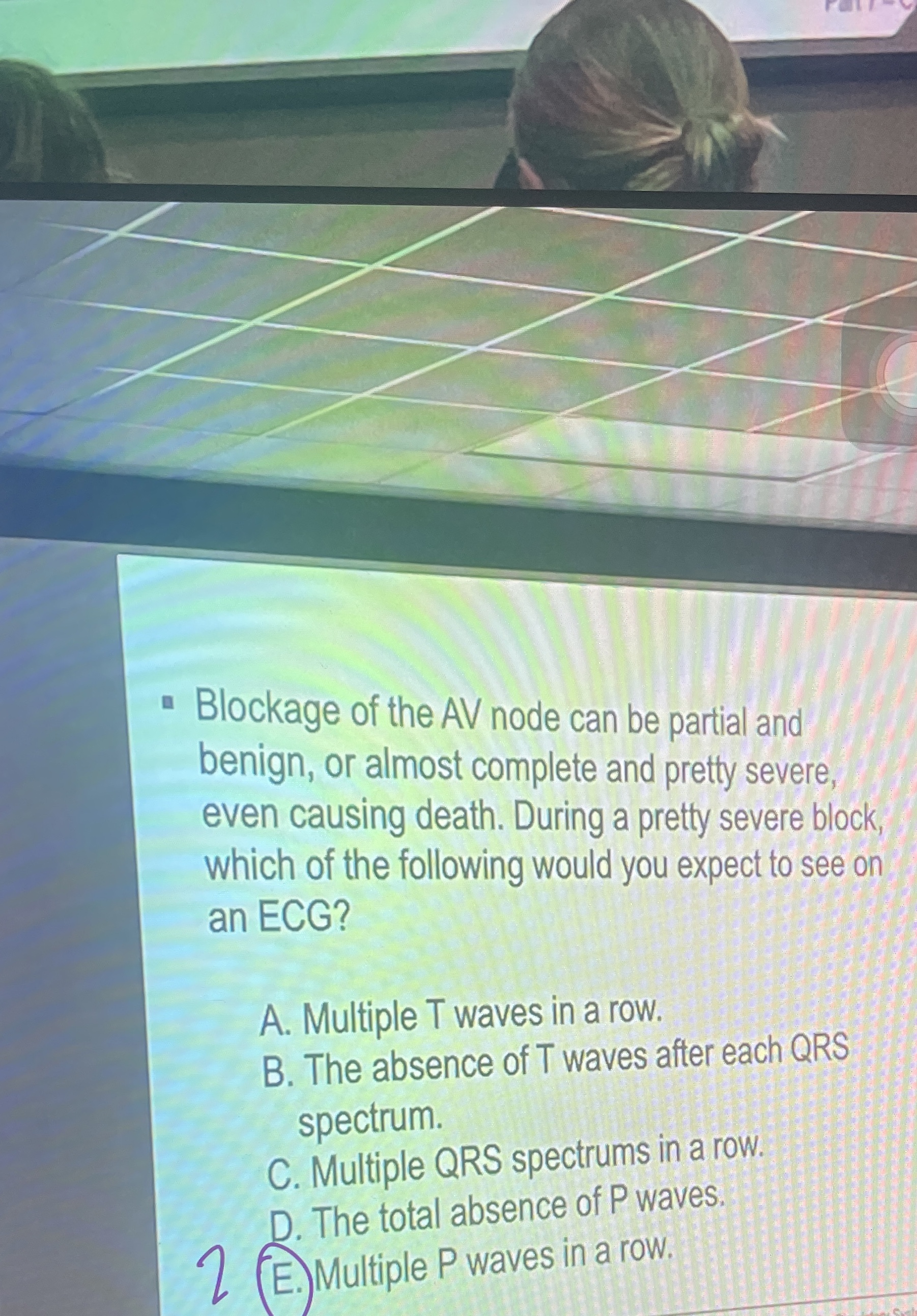 Solved Blockage of the AV node can be partial and benign, or | Chegg.com