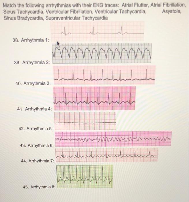 ventricular flutter