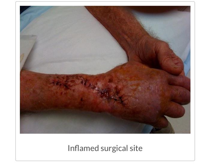 Inflamed surgical site