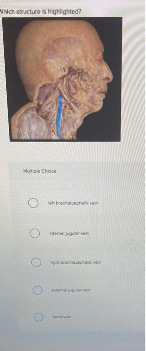 Which structure is highlighted?
Multiple Choice
left brachiocephalic vein
internal jugular vein
right brachiocephalic vein
ex