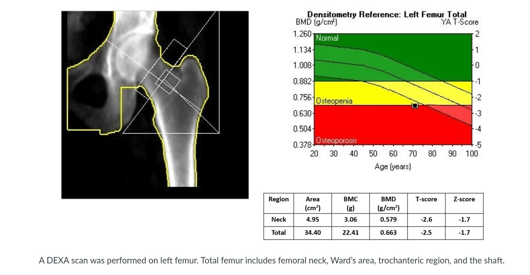 A DEXA scan was performed on left femur. Total femur includes femoral neck, Wards area, trochanteric region, and the shaft.