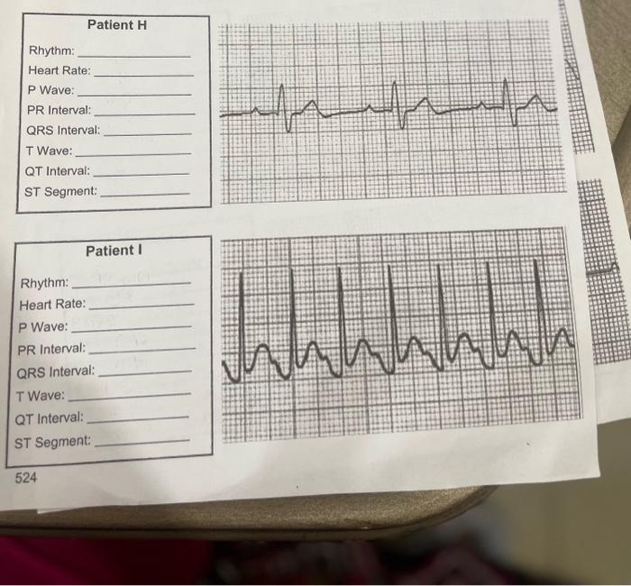 Patient H Rhythm: Heart Rate: P Wave: PR Interval: QRS Interval: T Wave: QT Interval: ST Segment: Patient I Rhythm: Heart Rat