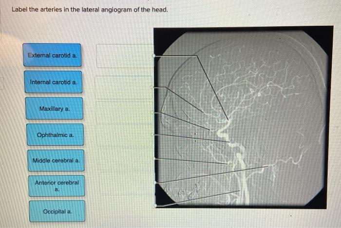 Solved Label the arteries in the lateral angiogram of the | Chegg.com