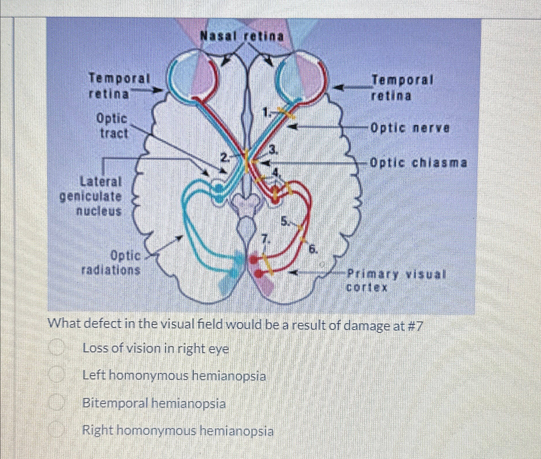 Solved What defect in the visual field would be a result of | Chegg.com