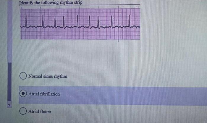 atrial fibrillation rhythm strip