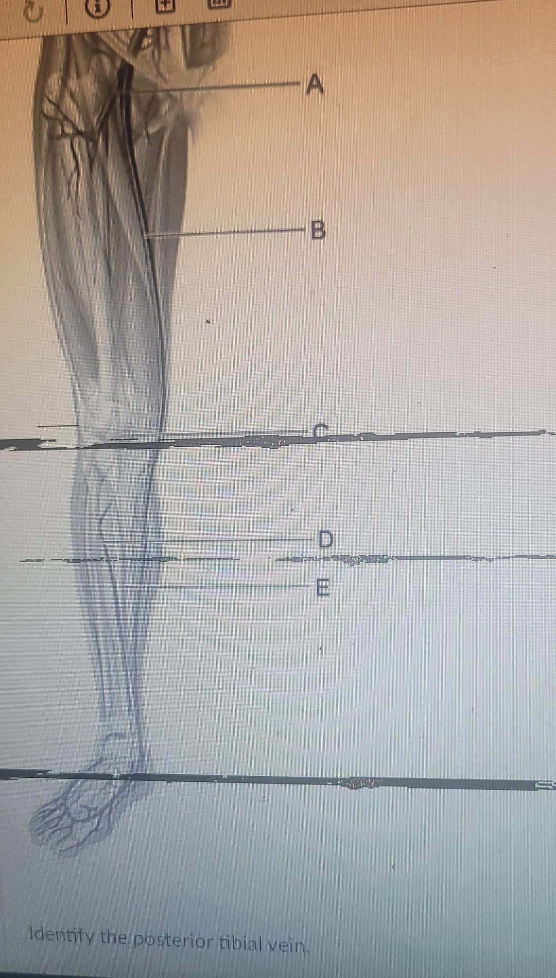 Identify the posterior tibial vein.