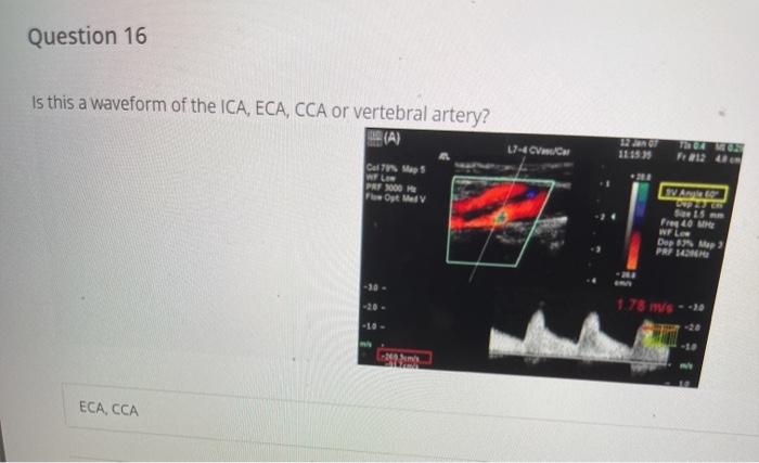 Solved Question 7 What abnormality is seen in this vertebral | Chegg.com