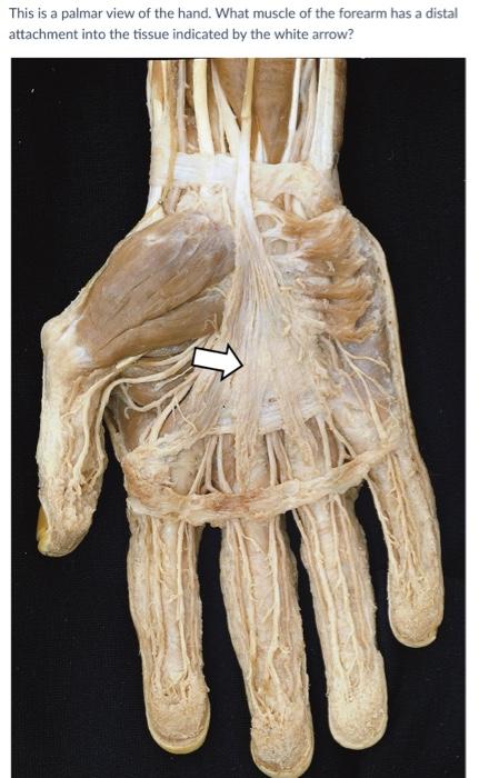 This is a palmar view of the hand. What muscle of the forearm has a distal