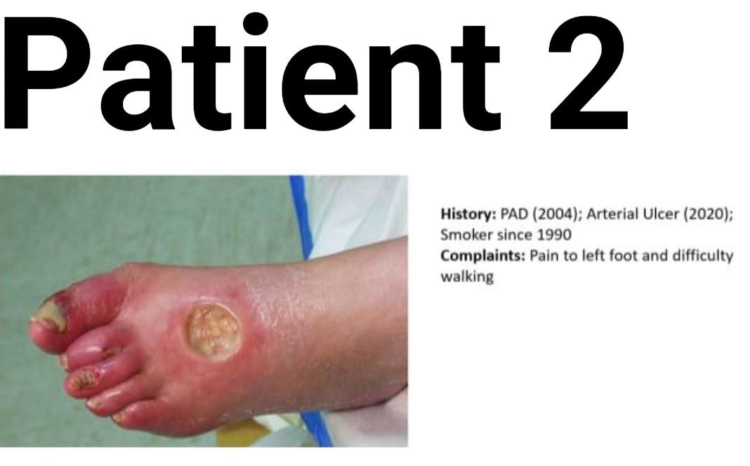 Patient 2 History: PAD (2004); Arterial Ulcer (2020); Smoker since 1990 Complaints: Pain to left foot and difficulty walking
