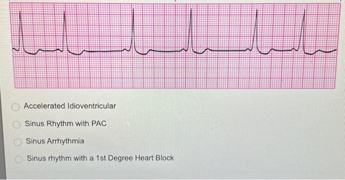 Solved 2nd Degree Heart Block Type II Sinus Rhythm with PJC | Chegg.com