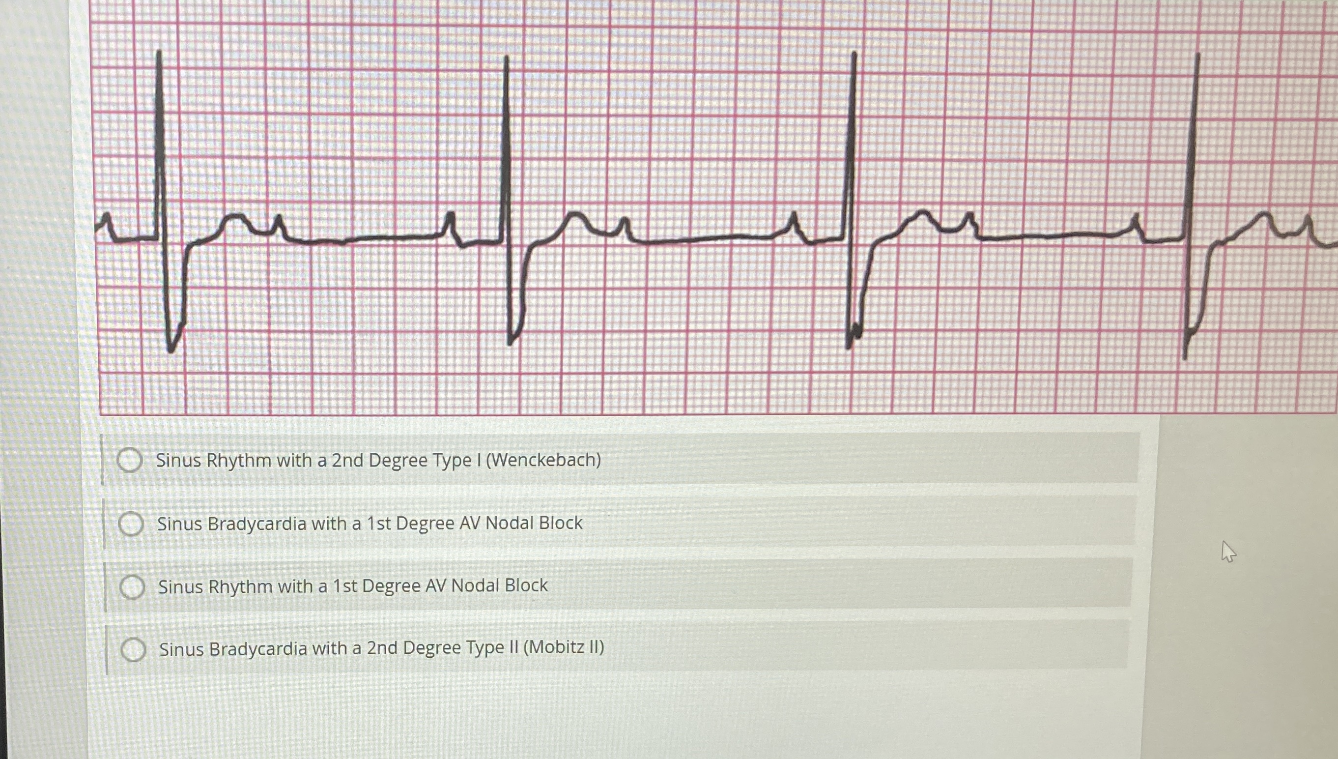 Solved Sinus Rhythm with a 2nd Degree Type I | Chegg.com