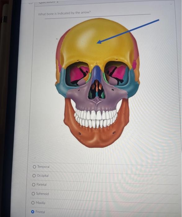 Temporal
Occipital
Parietal
Sphenoid
Moxilla
Frontal